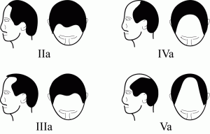 Norwood Classification